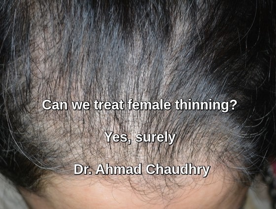 Female hair regrowth treatment clinic Lahore