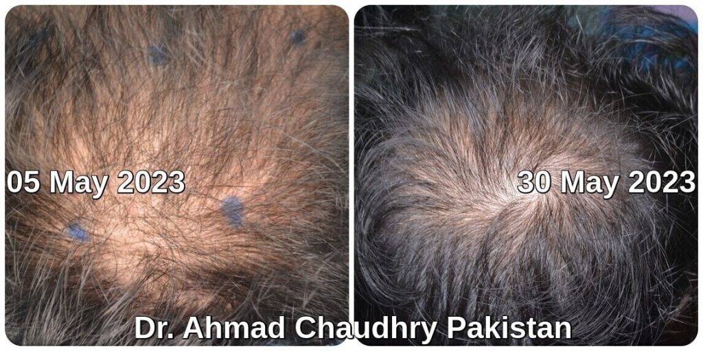 Hair treatment Pakistan