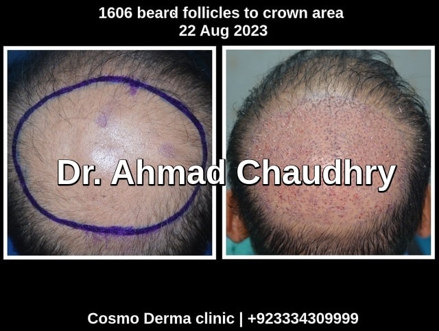 Fue before after Tunisia patient
