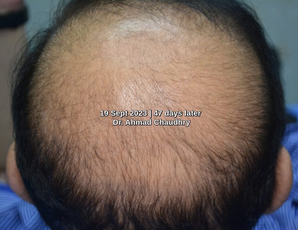 Hair regrowth crown area after treatment 47 days later