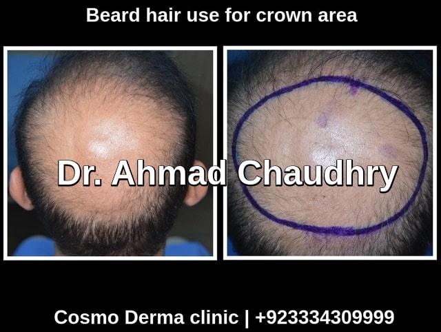 Hair transplant Tunisia