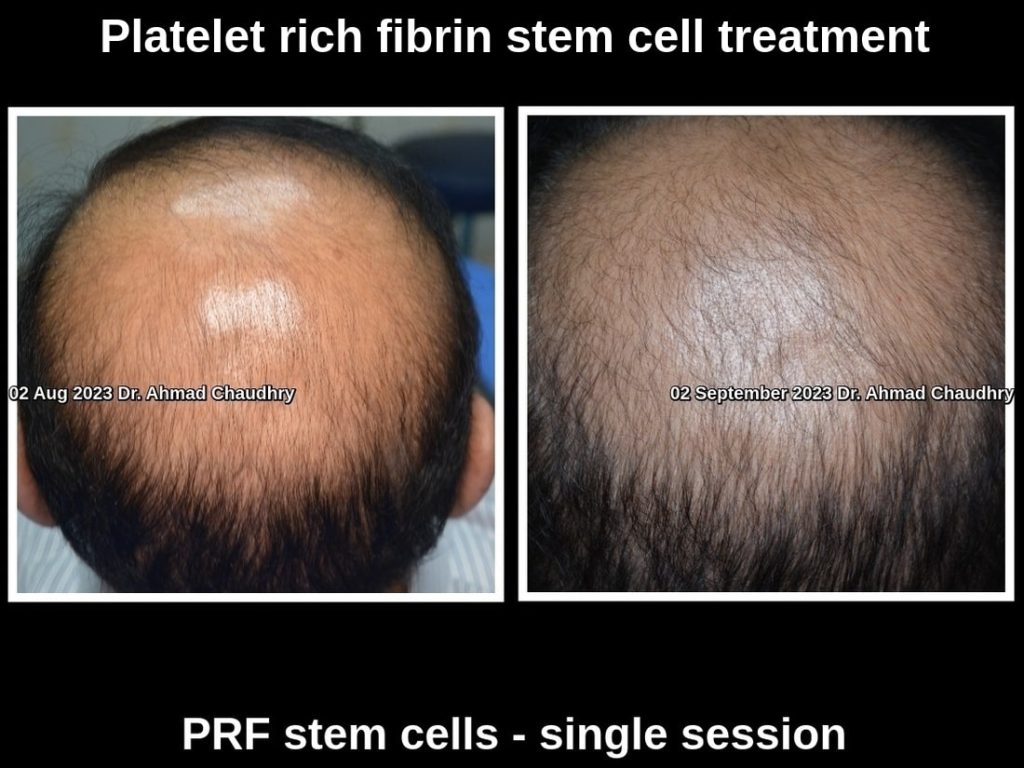Most effective hair regrowth treatment Lahore Pakistan